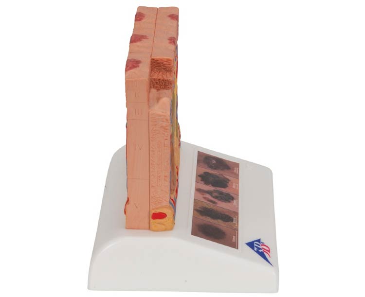 3B Scientific Skin Cancer Stages Model