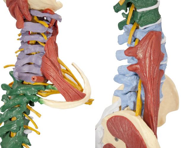 Muscle Spine With Disorders Model with Stand