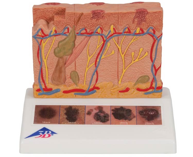 3B Scientific Skin Cancer Stages Model