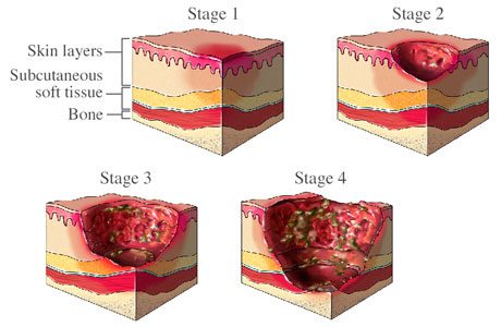 Stages for Ulcers