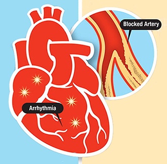 Cardiac Arrest vs. Heart Attack