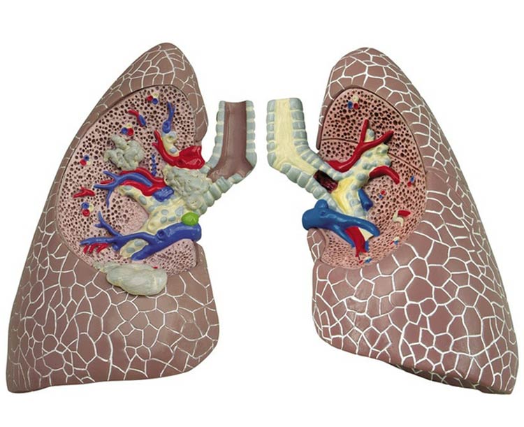 Diseased Lung Model