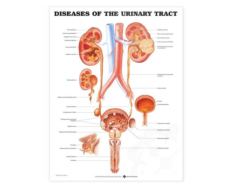 Anatomical World Wide Diseases Of The Urinary Tract Laminated Anatomical Chart