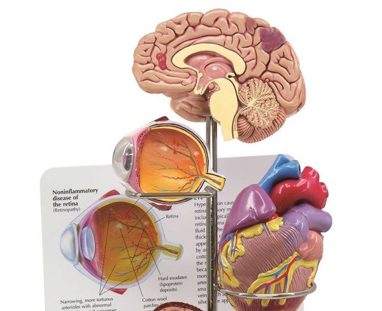 Hypertension Anatomy Model Set