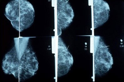 Mammogram X-Rays