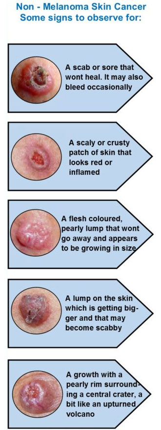 Skin Cancer Signs