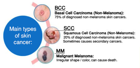 Types of Skin Cancer