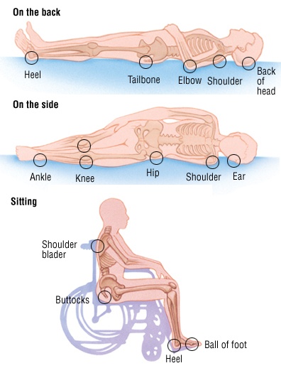 Pressure Care