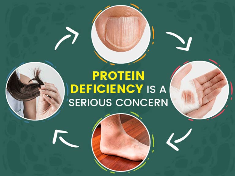 4 Signs Of Protein Deficiency And Why You Should Care