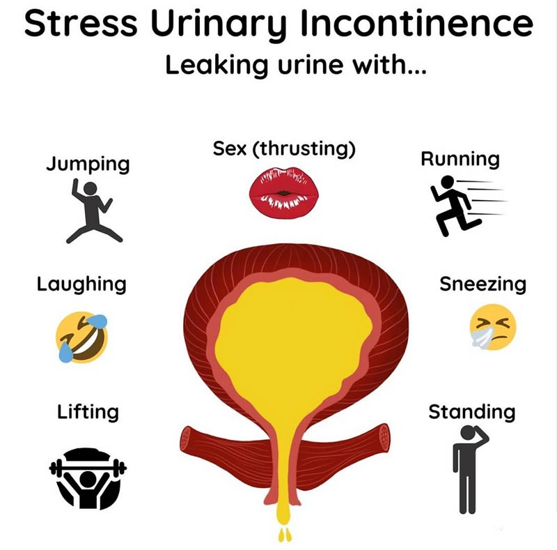 Understanding Stress Urinary Incontinence