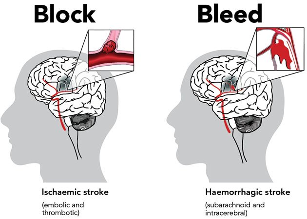 Types of Stroke